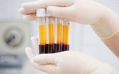 Benefits of Platlet-Rich Fibrin (PRF)