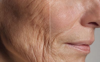 What Causes Facial Aging? Volume Loss vs Skin Quality